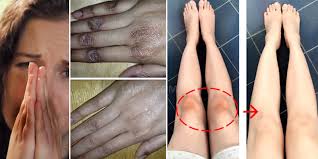How to Treat Stubborn Dark Knuckles, Elbows & Knees | Grerivian Solutions & DIY Remedies